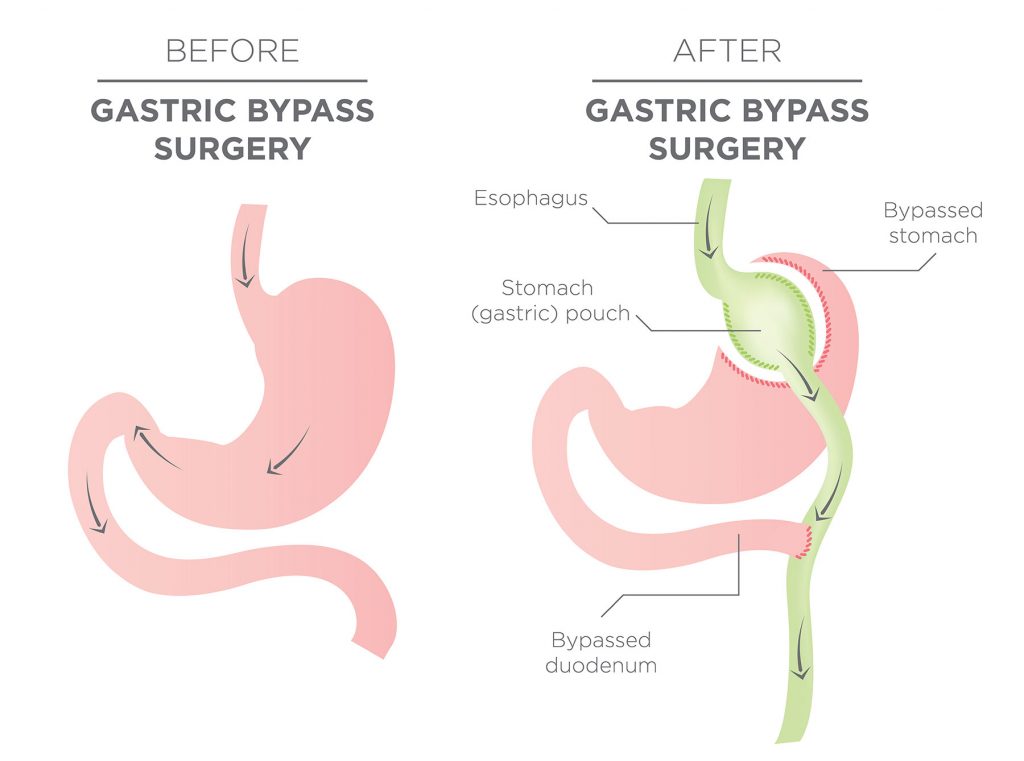 Before and After Gastric Bypass Surgery
