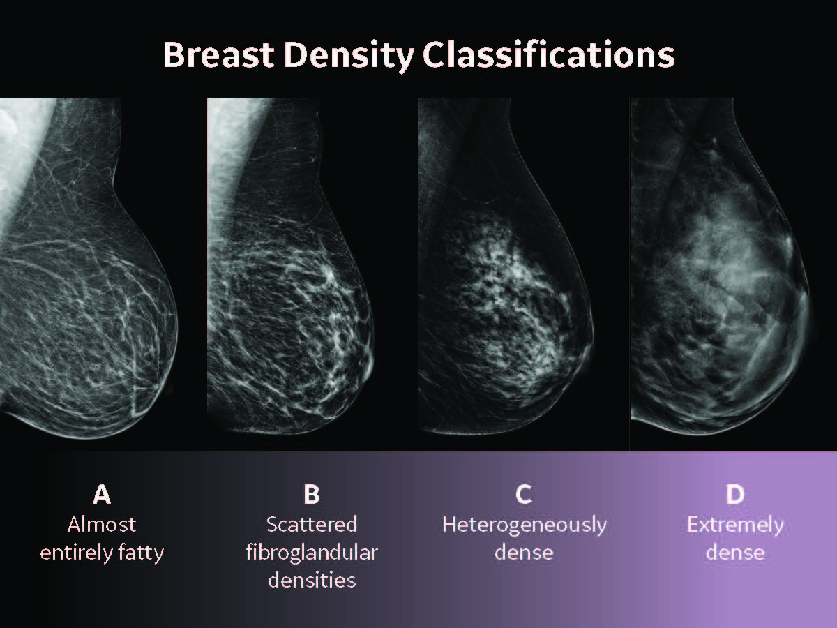 Automated Breast Ultrasound (ABUS) | Florence, AL